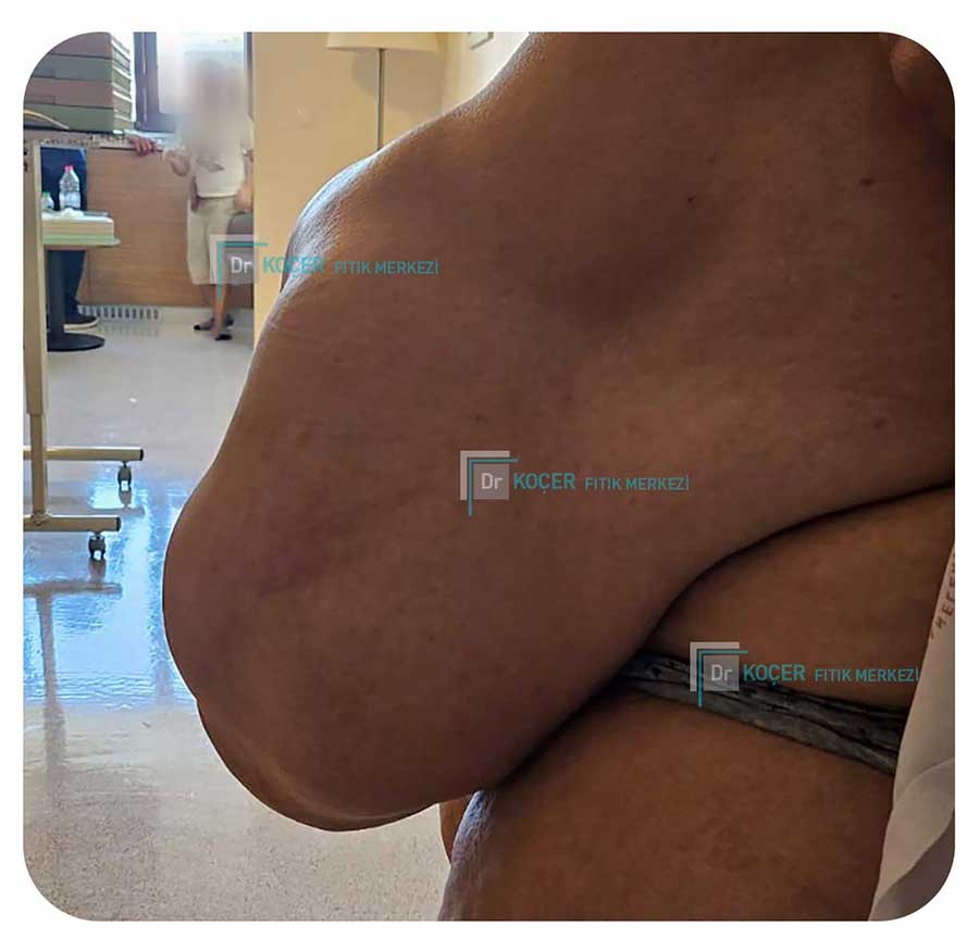 Dev Fıtık Vaka Örnekleri