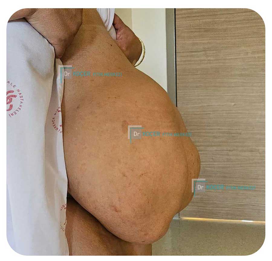 Dev Fıtık Vaka Örnekleri