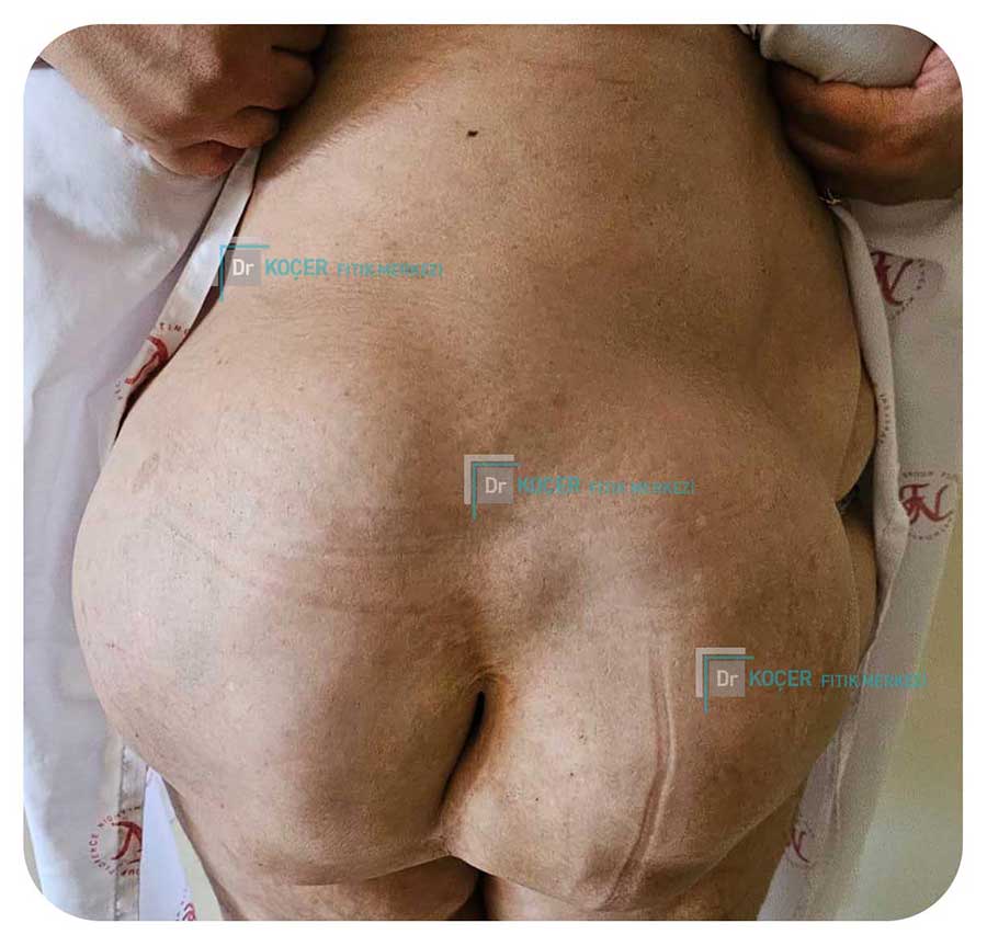 Dev Fıtık Vaka Örnekleri