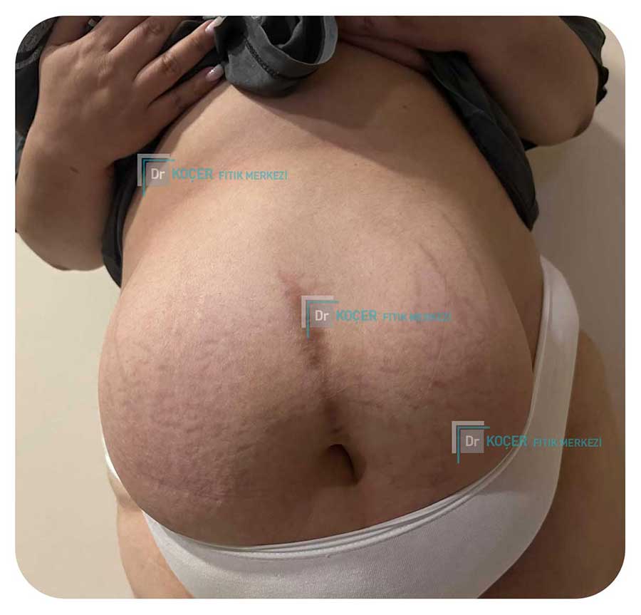 Dev Fıtık Vaka Örnekleri