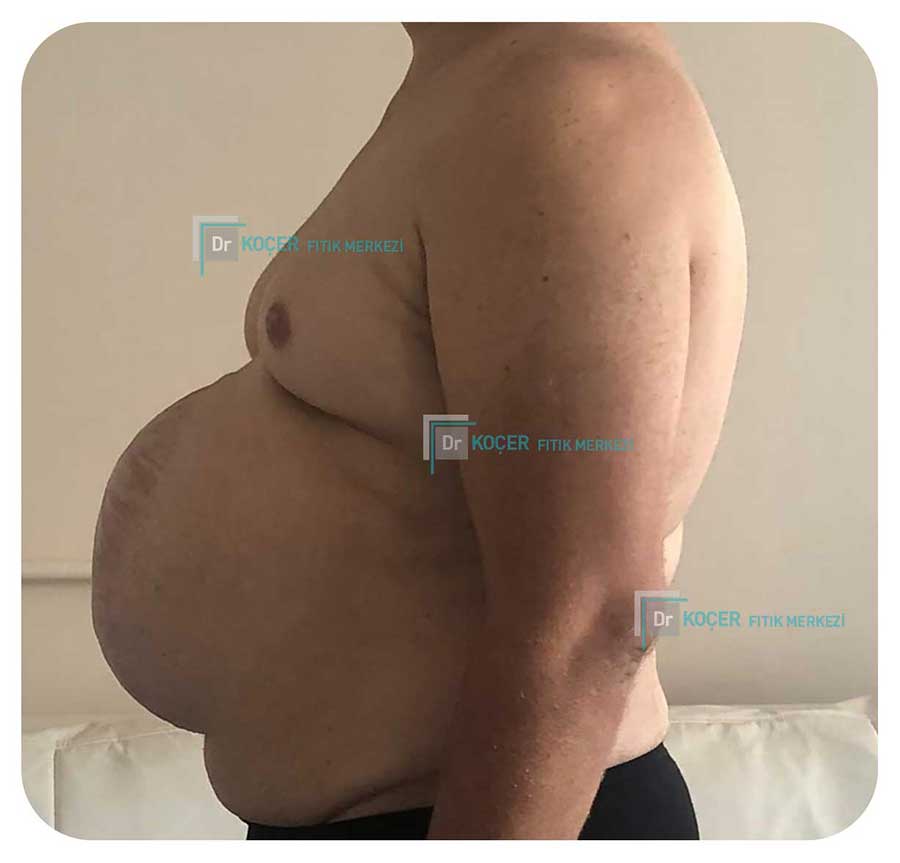 Dev Fıtık Vaka Örnekleri